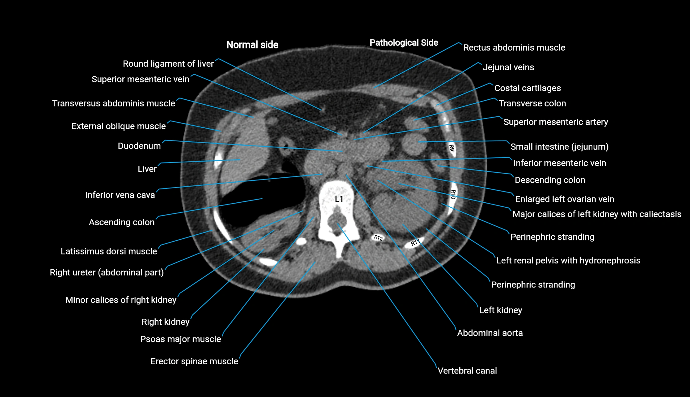 CT KUB axial cross sectional anatomy  radiology image -img-00201-00043.webp